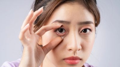 Kemenkes Catat Kebutaan Katarak Capai 650 Ribu Kasus di 2025,